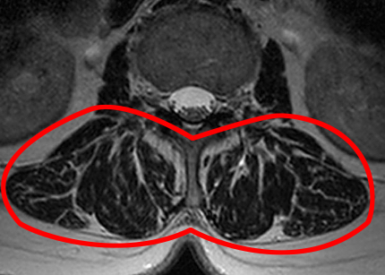 図MRI. 正常の人の場合：筋肉が厚くて肉質も良好（左）